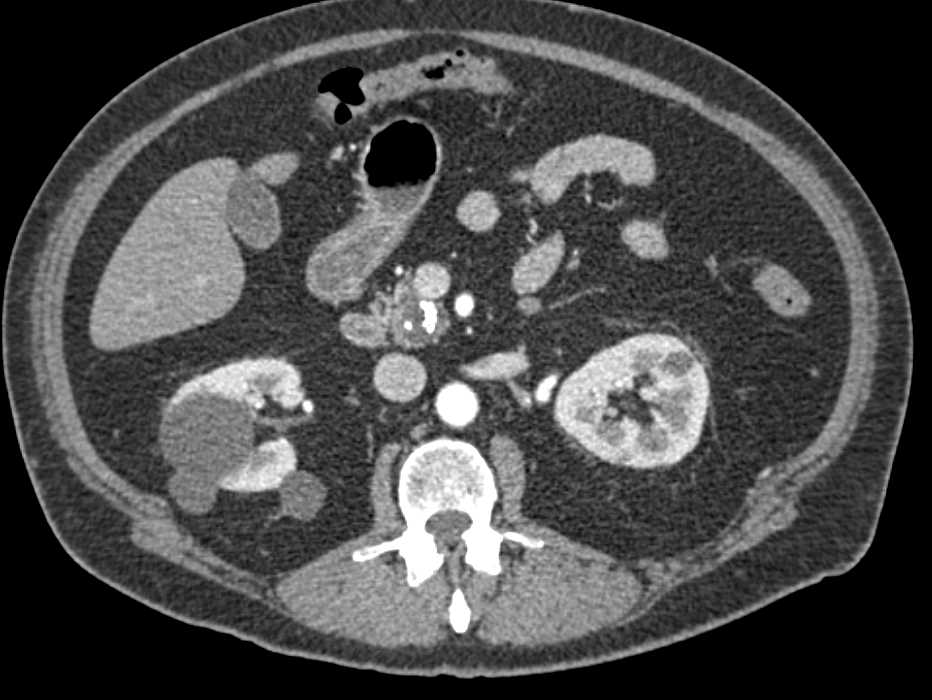 Chronic Pancreatitis with Pseudocyst - CTisus CT Scan