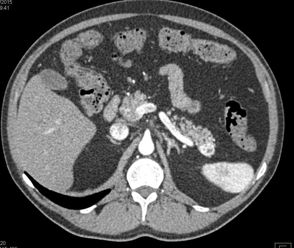 1cm Neuroendocrine Tumor Tail of Pancreas - CTisus CT Scan