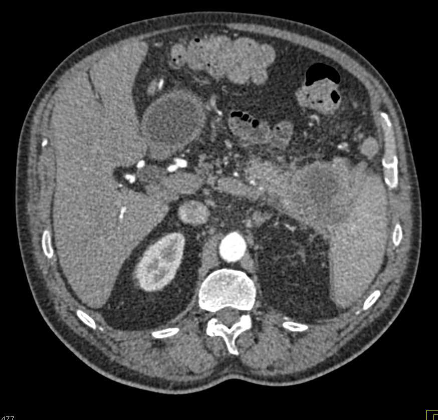 Carcinoma Tail of Pancreas - CTisus CT Scan