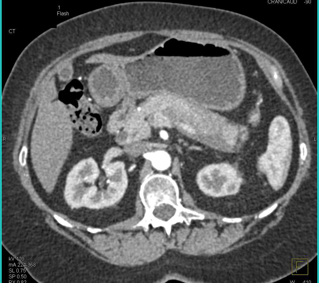 Autoimmune Pancreatitis - CTisus CT Scan