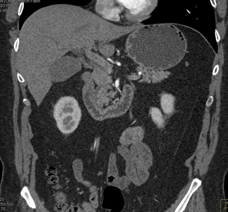 Ampullary Carcinoma - CTisus CT Scan