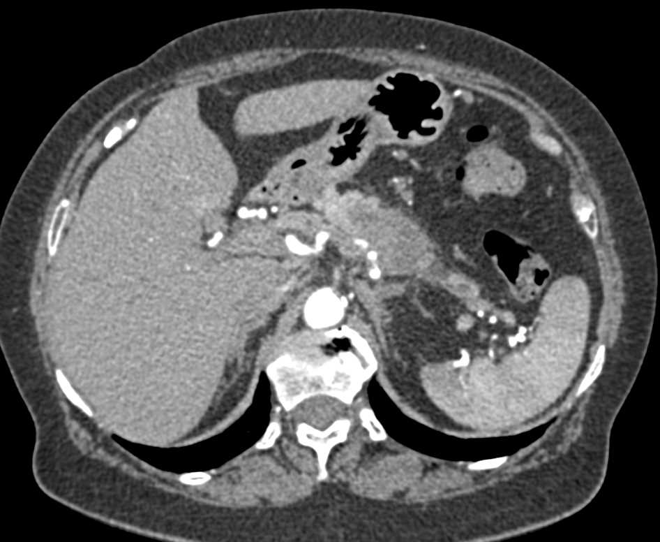 Pancreatic Adenocarcinoma with Arterial and Venous Involvement - CTisus CT Scan