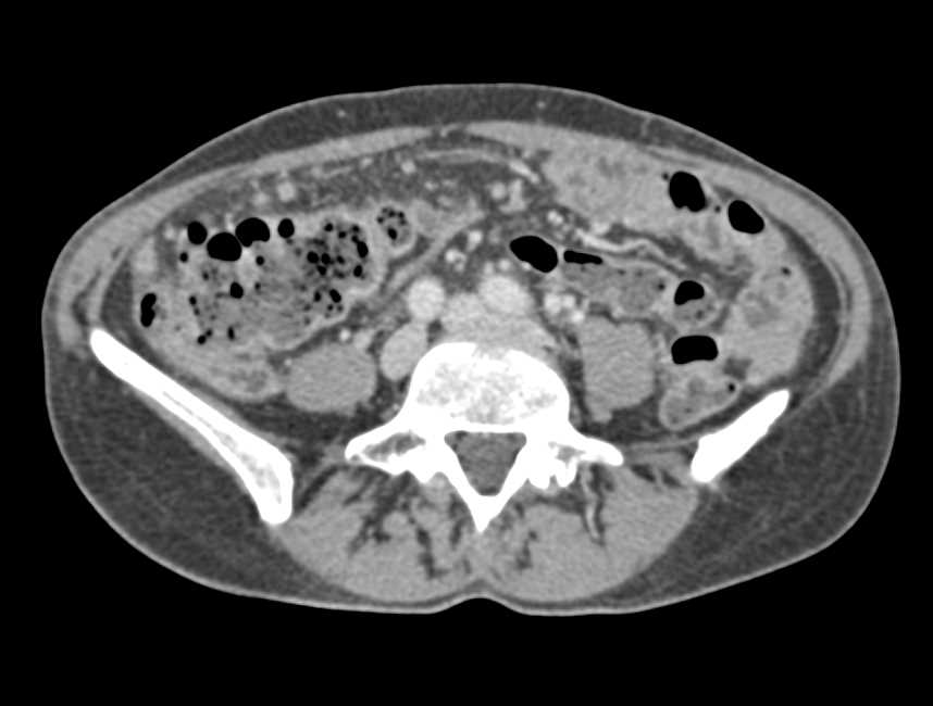 Carcinomatosis from a Pancreatic Primary - CTisus CT Scan