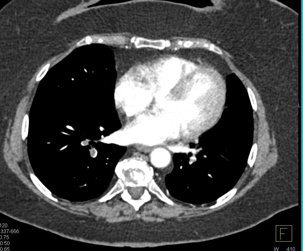 Pulmonary Embolism in Patient with Pancreatic Cancer - CTisus CT Scan