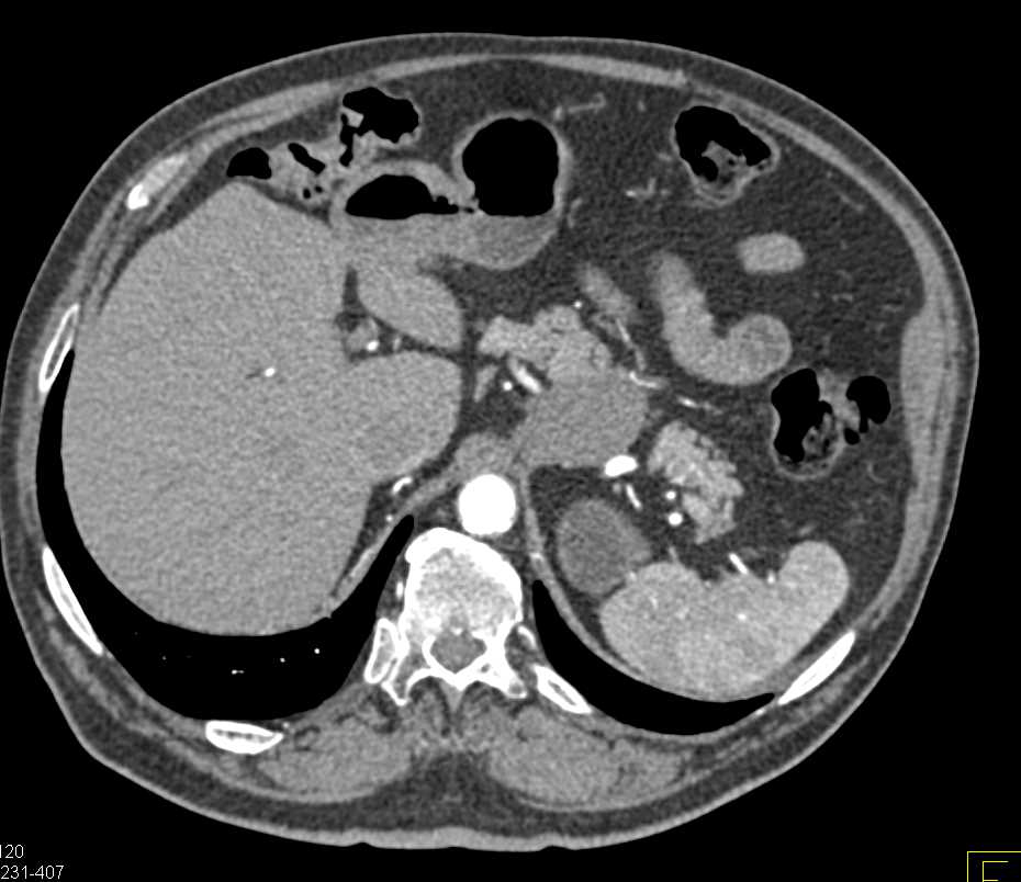 Carcinoma of the Pancreas - CTisus CT Scan