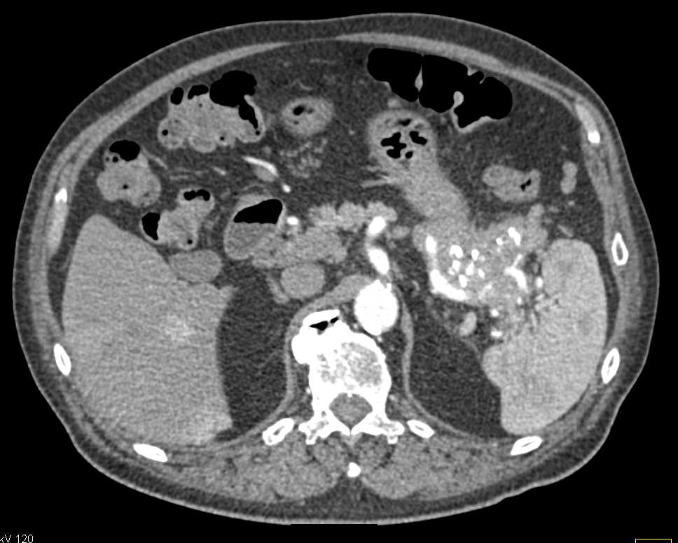 Pancreatic Neuroendocrine Tumor (PNET) Tail of Pancreas - CTisus CT Scan