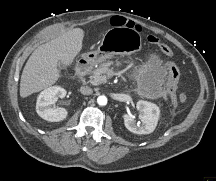 Acute Pancreatitis with Pancreatic Necrosis - CTisus CT Scan