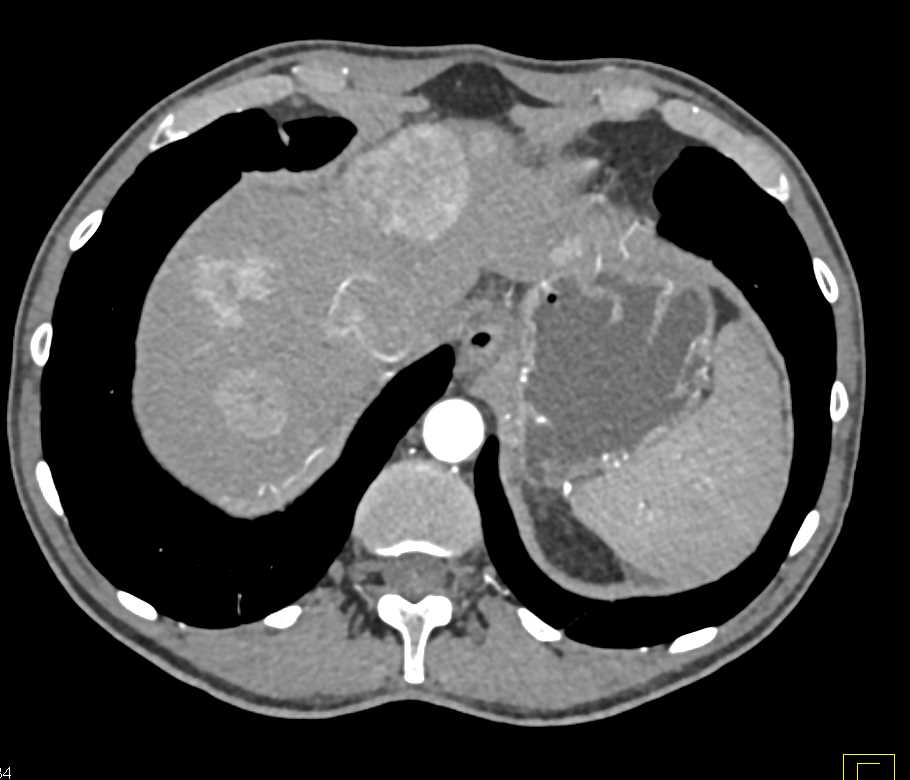 Pancreatic Neuroendocrine Tumor (PNET) of the Tail of the Pancreas with Liver Metastases - CTisus CT Scan