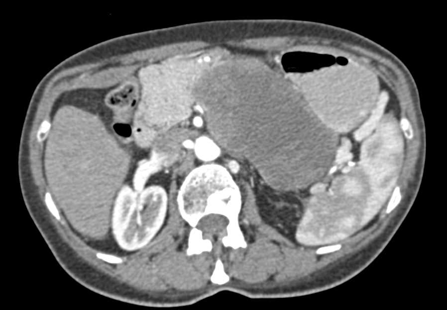 Cystadenocarcinoma Tail of Pancreas - CTisus CT Scan