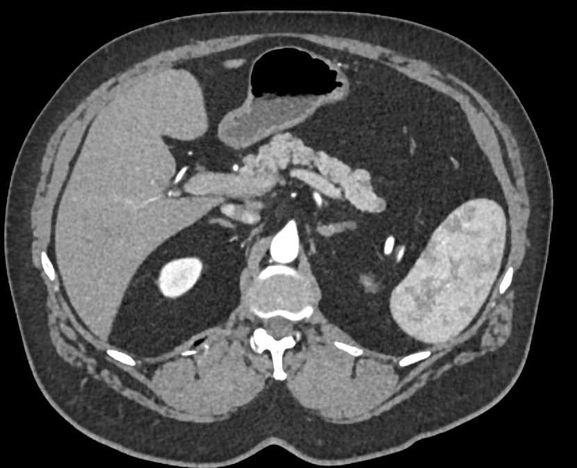 1cm Pancreatic Neuroendocrine Tumor (PNET) Tail of Pancreas - CTisus CT Scan