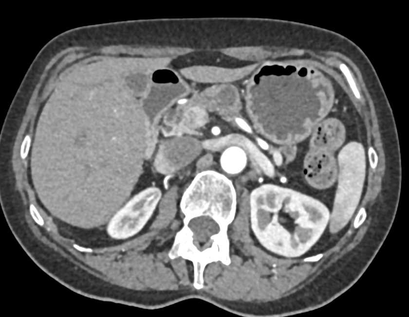 Adenocarcinoma Pancreas Arising in an Intraductal Papillary Mucinous Neoplasm (IPMN) - CTisus CT Scan