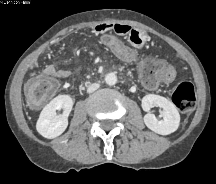 Infiltrating Pancreatic Adenocarcinoma and Pancreatic Cancer - CTisus CT Scan