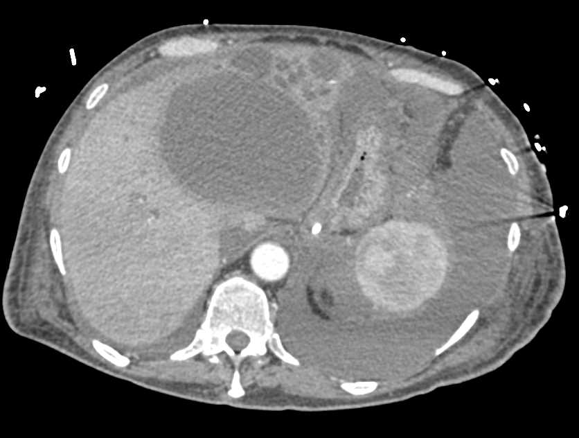 Necrotizing Pancreatitis with Extensive Air in Pancreatic Gland - CTisus CT Scan