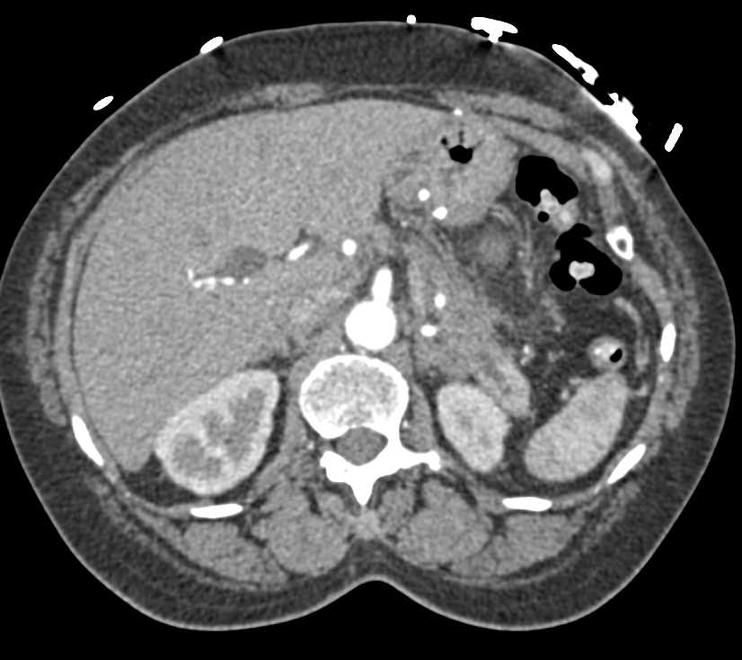 Pancreatic Cancer with Infiltration Into the Peripancreatic Region - CTisus CT Scan