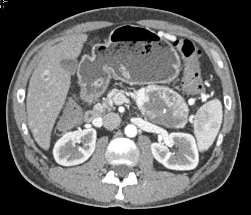 Neuroendocrine Tumor in the Tail of the Pancreas - CTisus CT Scan