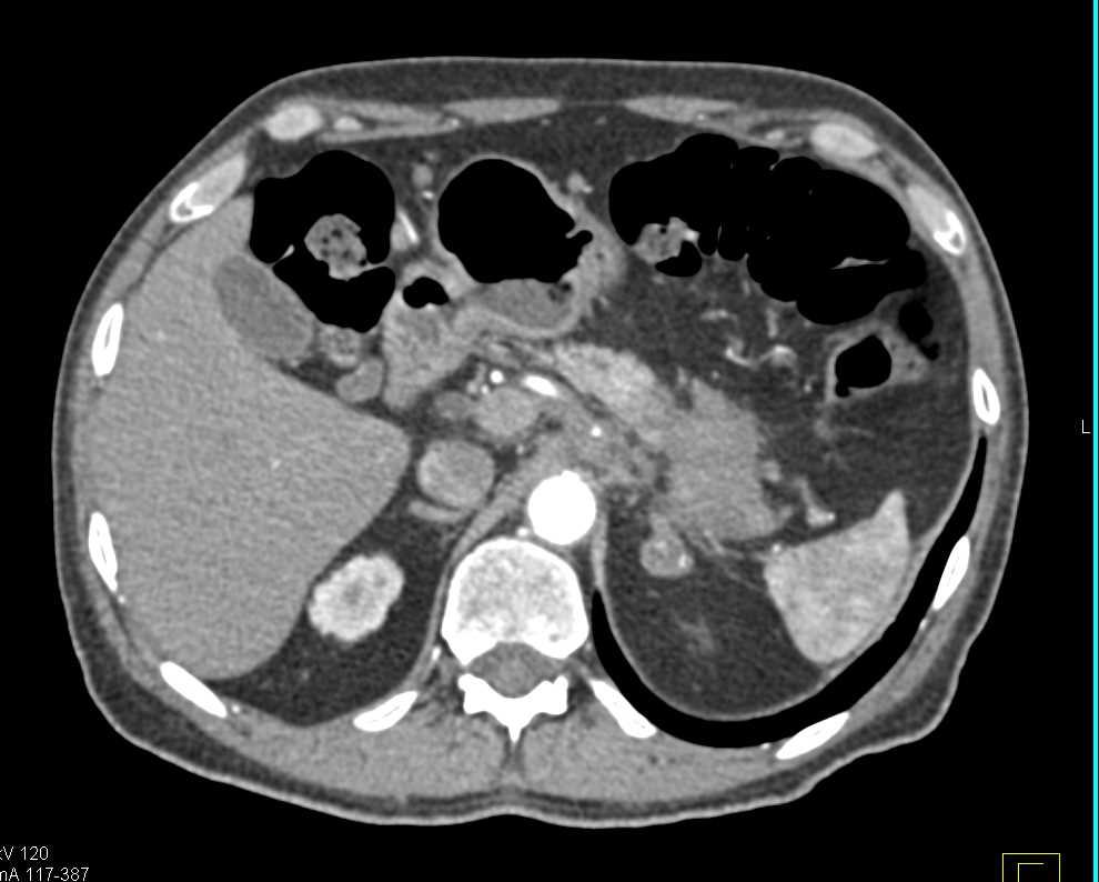 Carcinoma Tail of the Pancreas - CTisus CT Scan