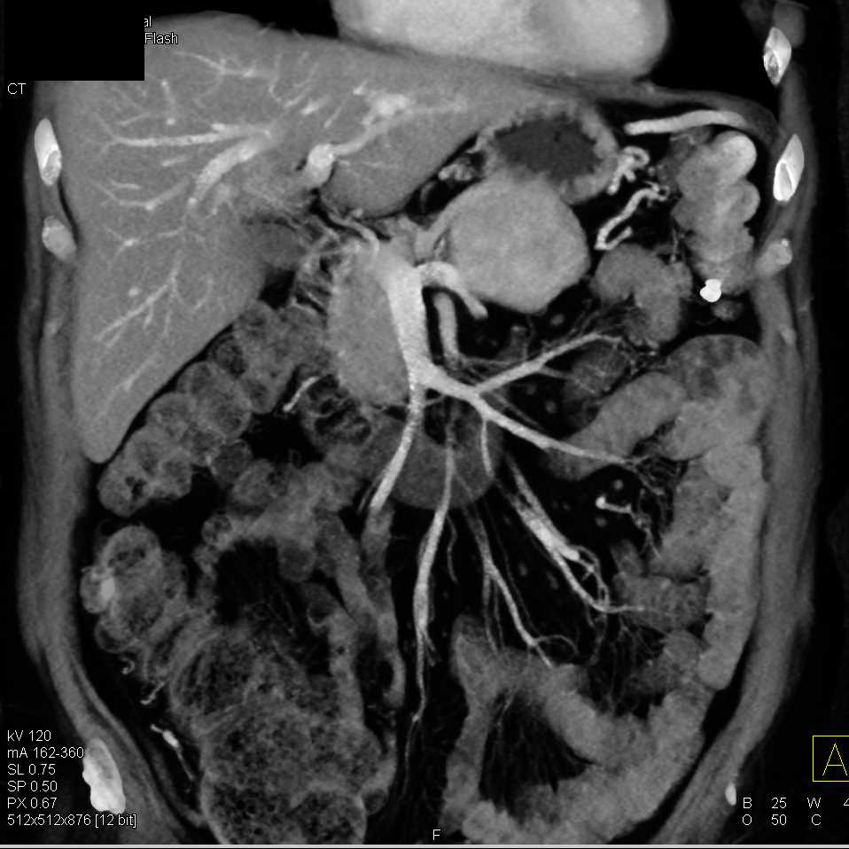 Neuroendocrine Tumor in the Tail of the Pancreas - CTisus CT Scan