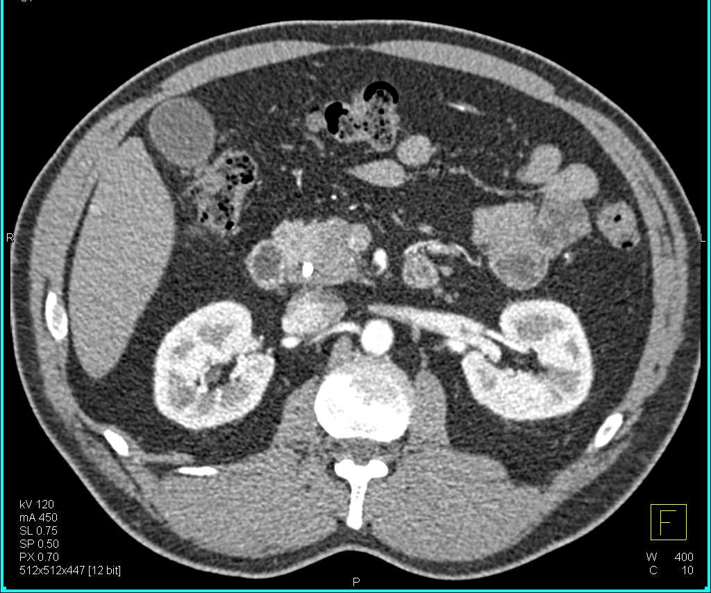 Adenocarcinoma Head of the Pancreas - CTisus CT Scan