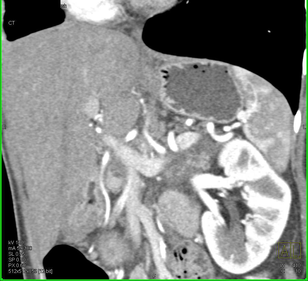 Subtle Pancreatic Cancer with Dilated Pancreatic Duct - CTisus CT Scan