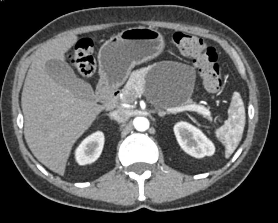 Serous Cystadenoma Pancreas - CTisus CT Scan