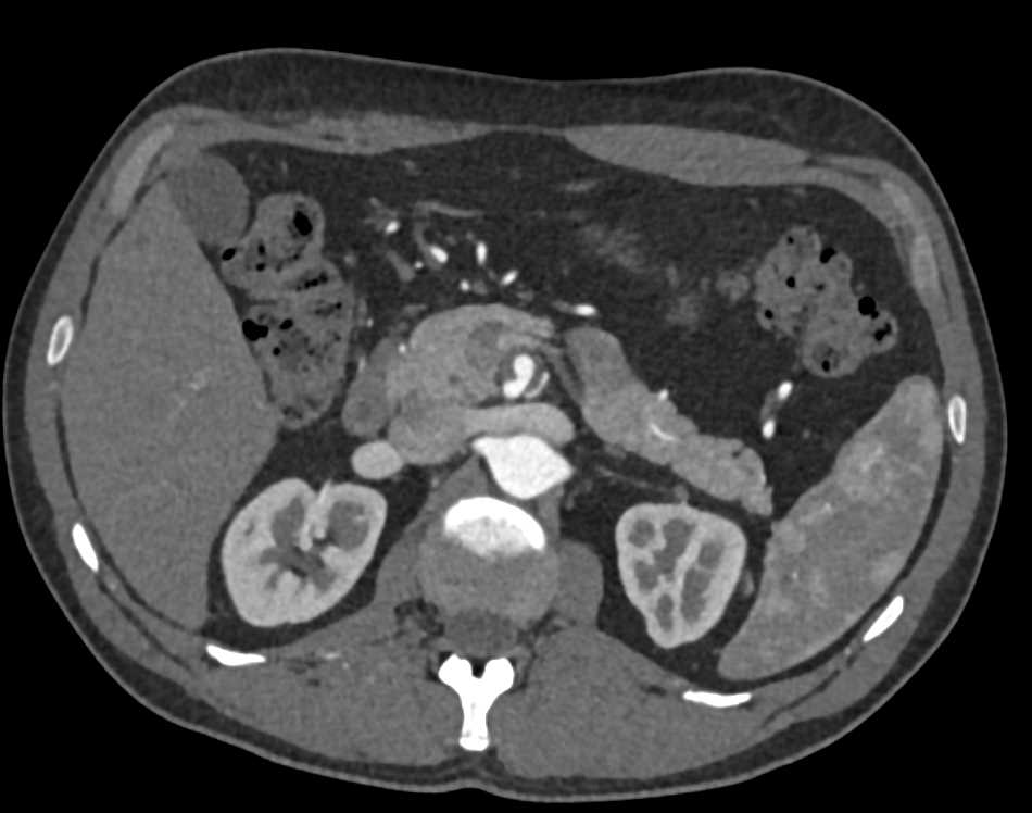 Subtle Pancreatic Cancer - CTisus CT Scan