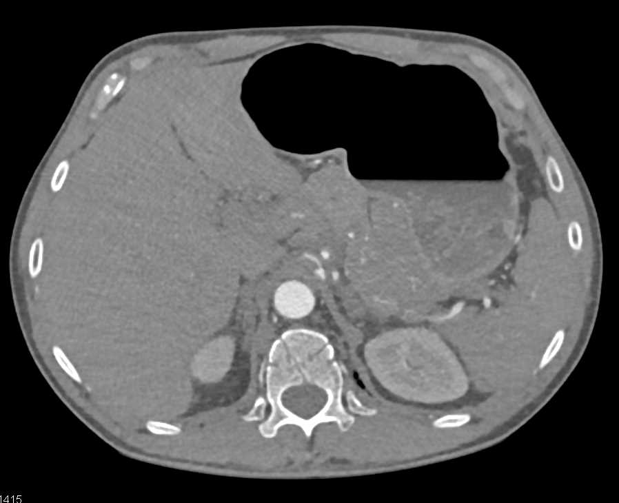 Pancreatic Cancer Encases the Celiac Artery and Narrows It - CTisus CT Scan