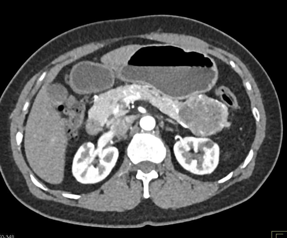 Solid and Papillary Epithelial Neoplasm (SPEN) Tumor in the Tail of the Pancreas - CTisus CT Scan