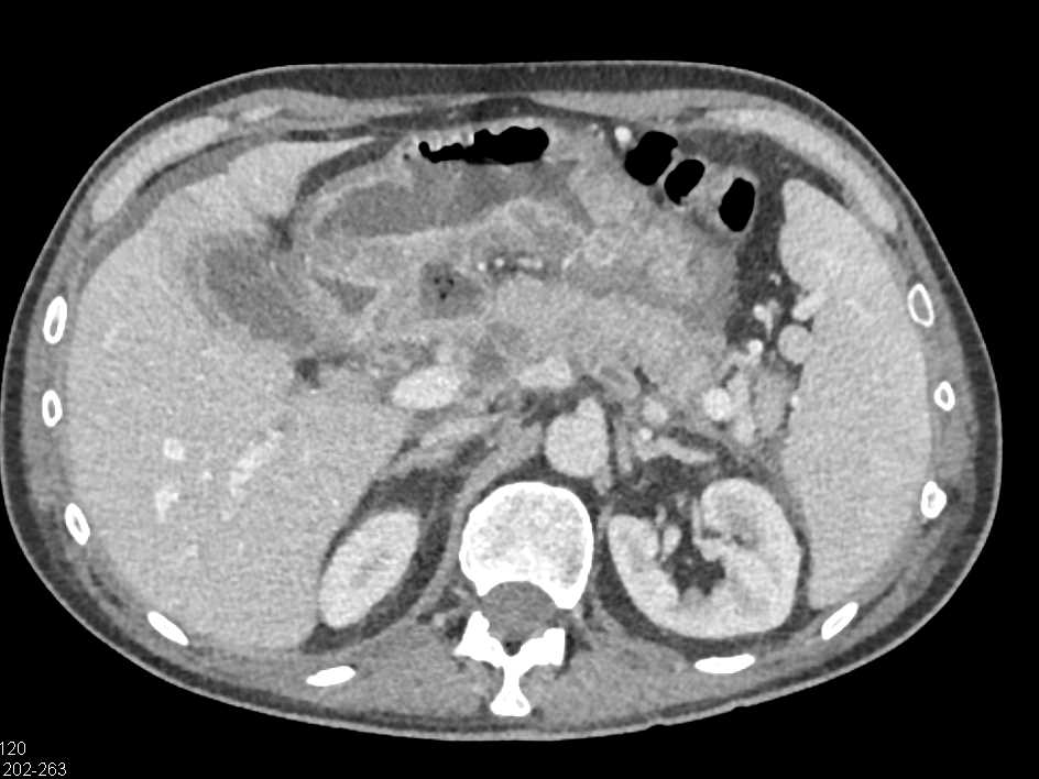 Acute Pancreatitis and Gastritis - CTisus CT Scan