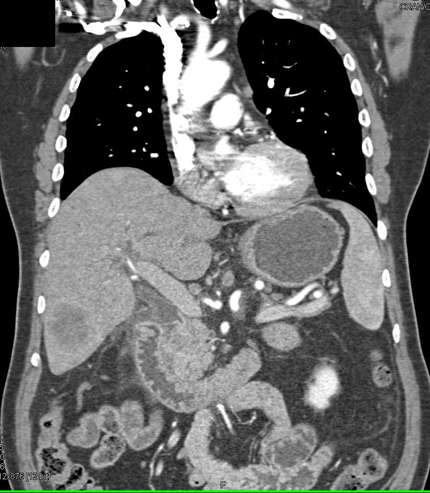 Pancreatic Cancer with Liver Metastases - CTisus CT Scan