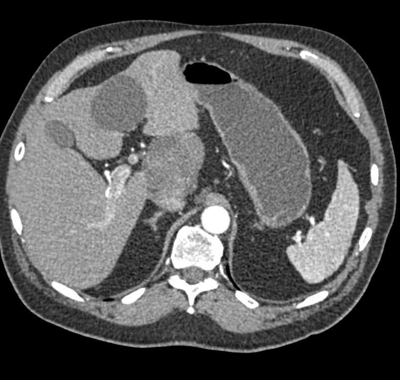 Ganglioneuroma Near Head of Pancreas - CTisus CT Scan