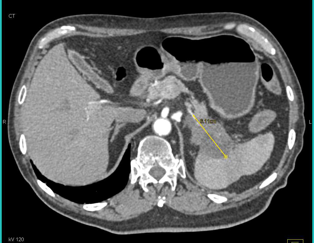 Adenocarcinoma Tail of the Pancreas - Pancreas Case Studies - CTisus CT