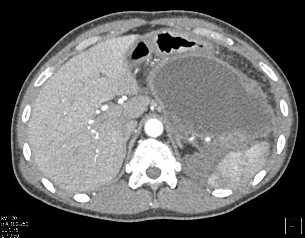 Pseudocyst Lesser Sac with Drain - CTisus CT Scan