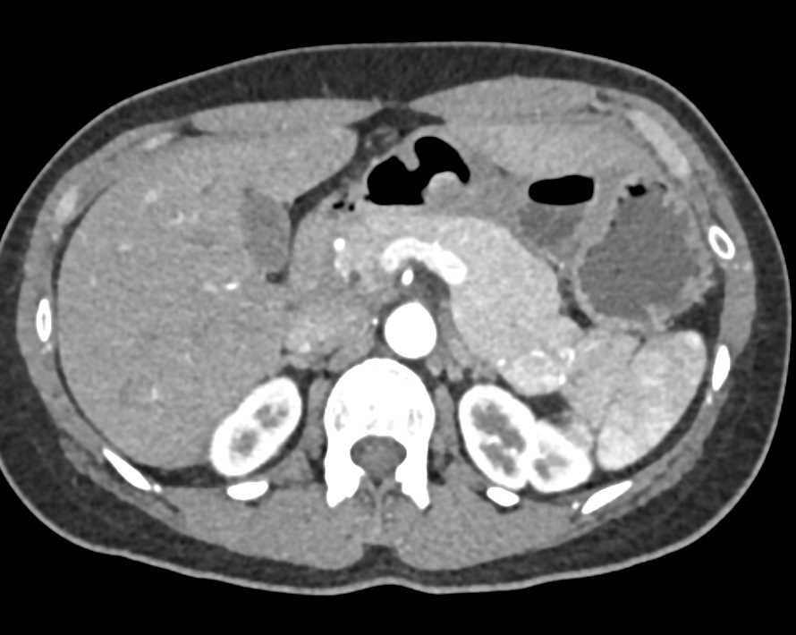 Neuroendocrine Tumor Tail of the Pancreas - CTisus CT Scan