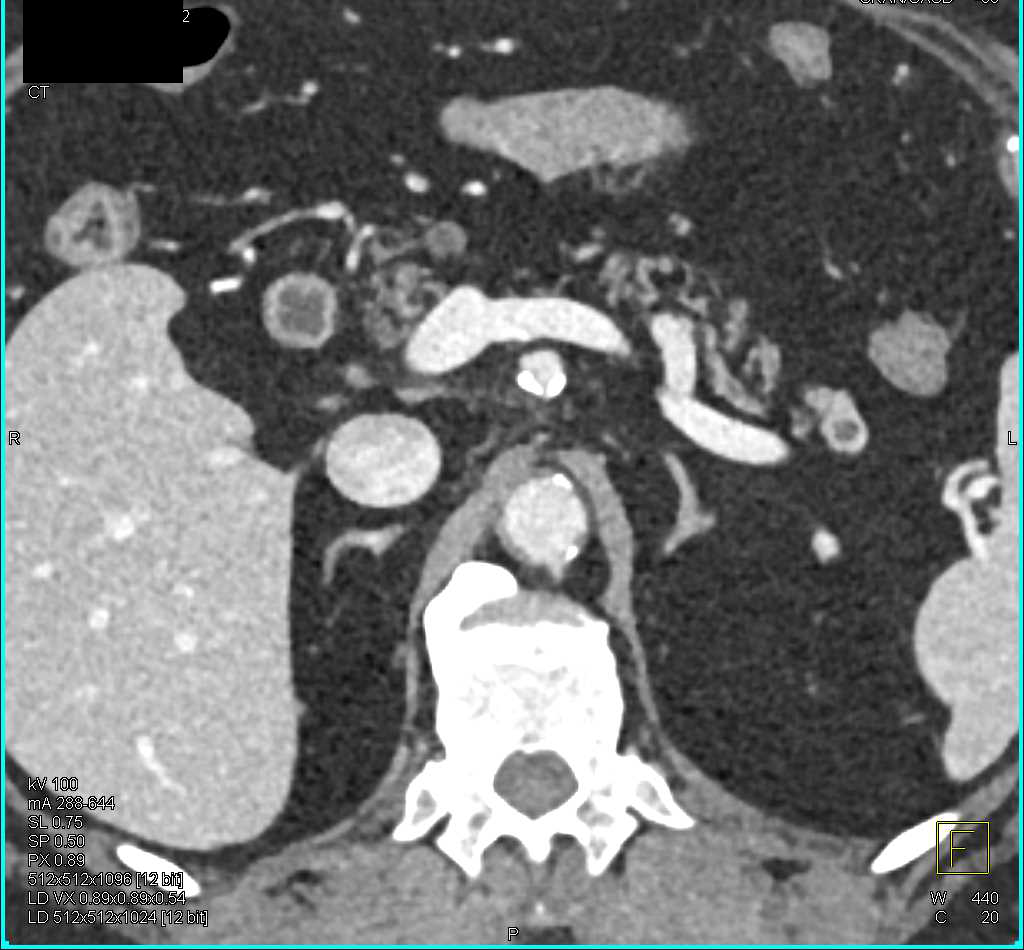 1cm Neuroendocrine Tumor in the Tail of the Pancreas - CTisus CT Scan