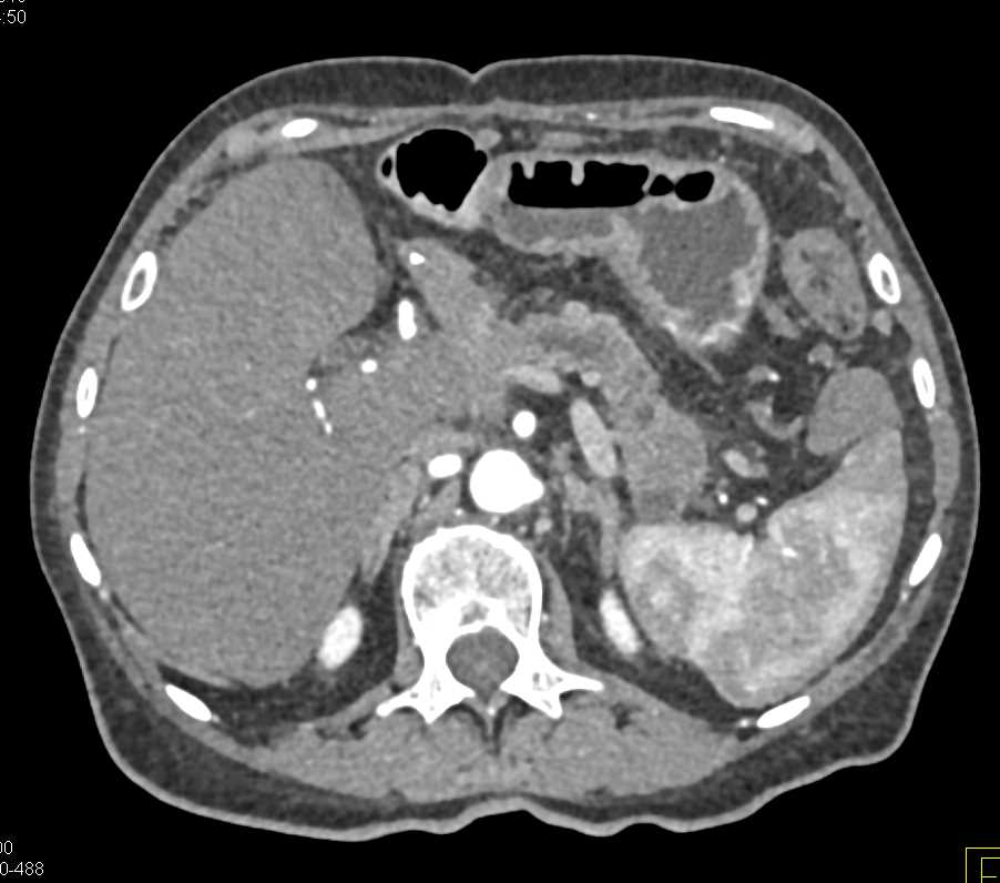 Invasive Carcinoma Head of the Pancreas - CTisus CT Scan