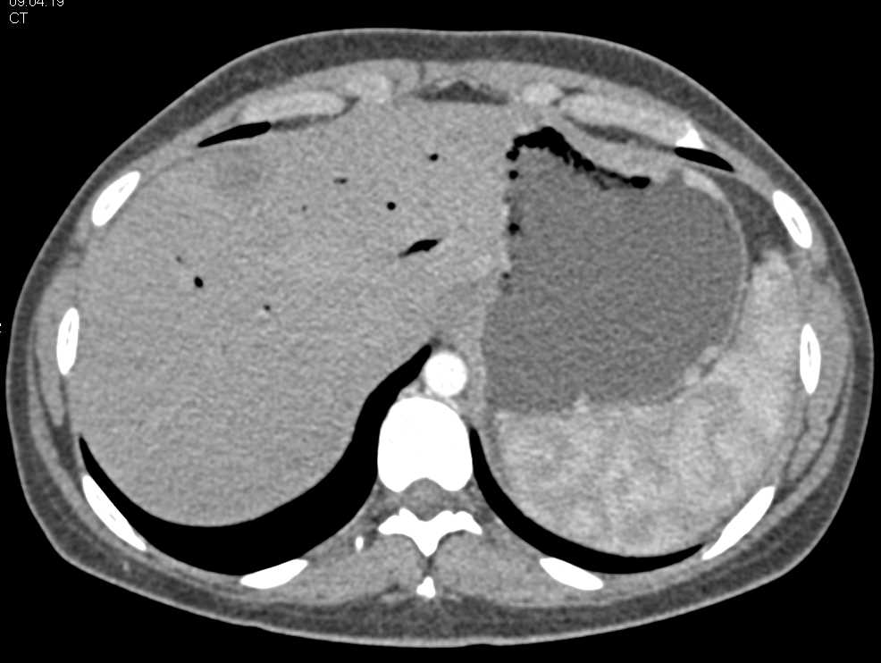 Recurrent Pancreatic Cancer with Liver Metastases - CTisus CT Scan