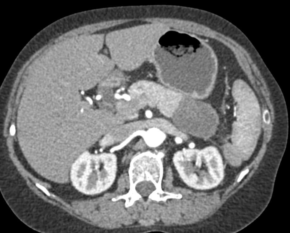 Carcinoma of the Tail of the  Pancreas - CTisus CT Scan