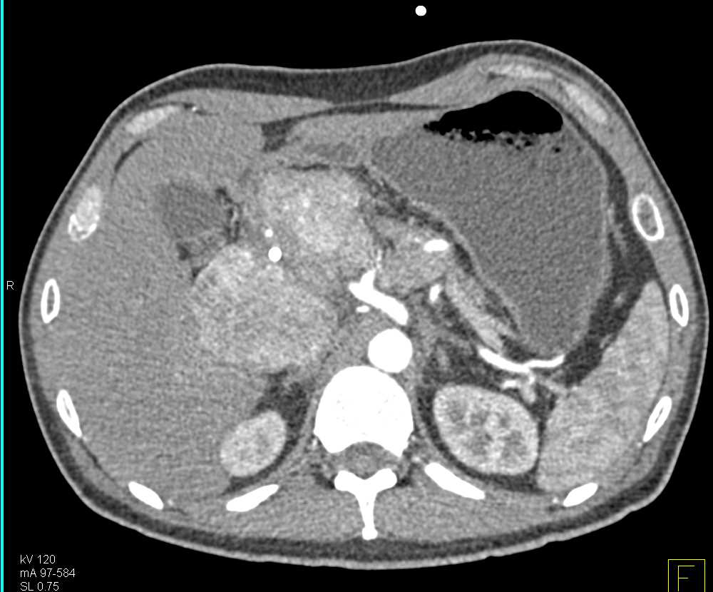 Neuroendocrine Tumor of the Pancreatic Head with Vascular Encasement - CTisus CT Scan