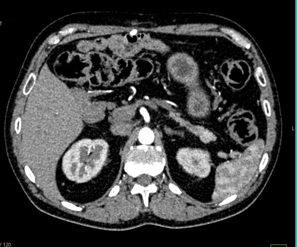 1cm Pancreatic Neuroendocrine Tumor (PNET) Tail of the Pancreas - CTisus CT Scan