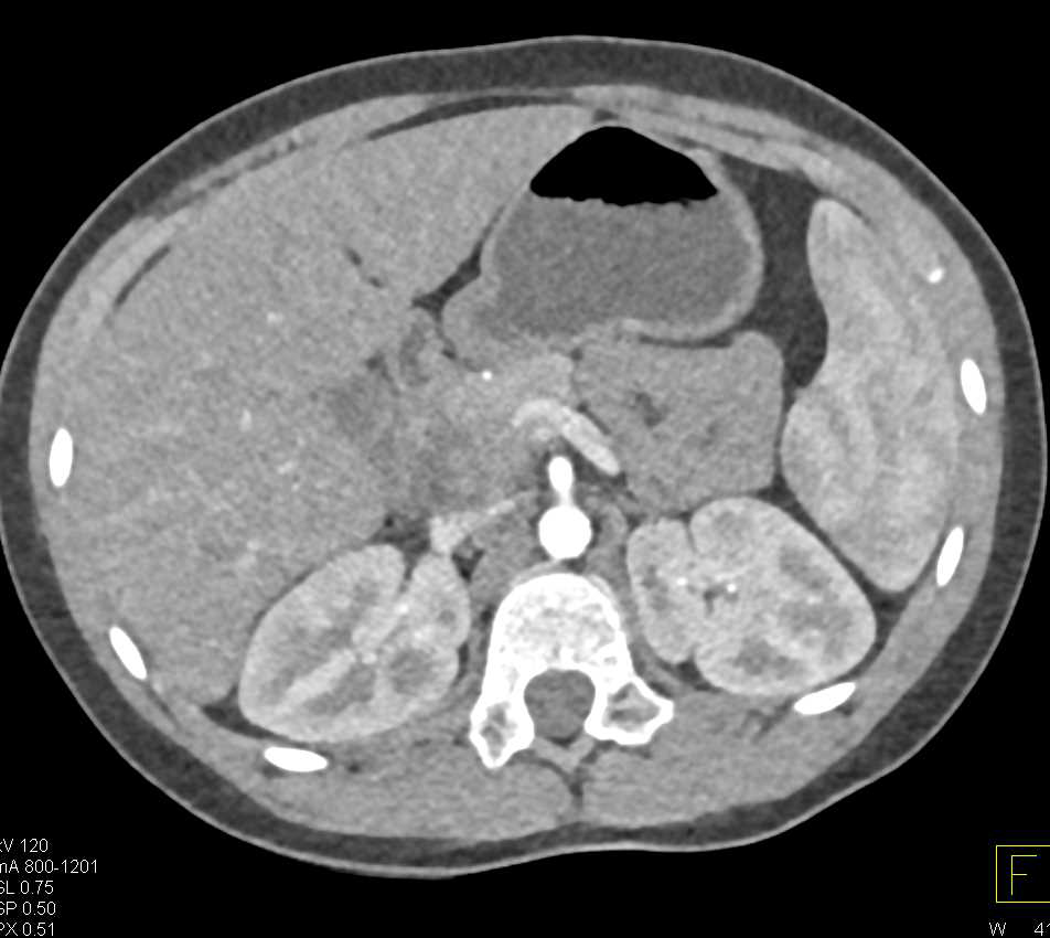 Pancreatic Adenocarcinoma - CTisus CT Scan