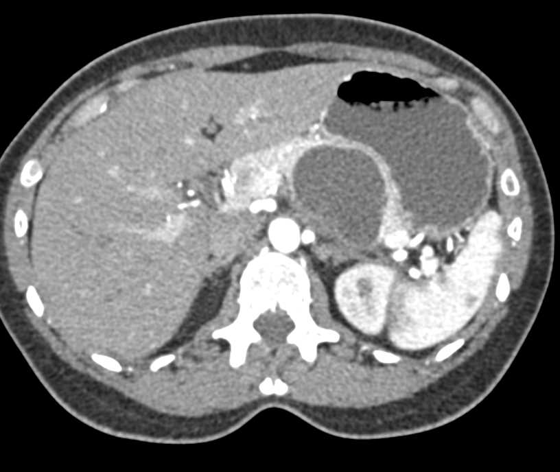 MCN (Mucinous Cystic Neoplasm) Body of the Pancreas - CTisus CT Scan