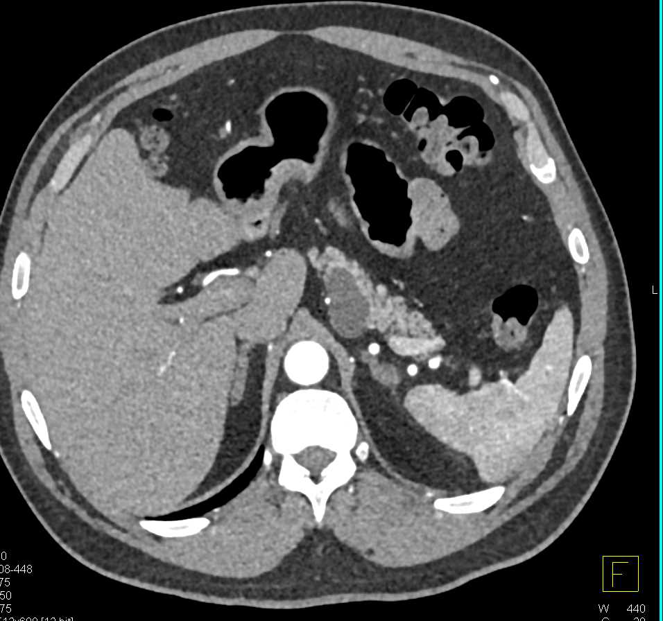 Intraductal Papillary Mucinous Neoplasm (IPMN) Pancreas - CTisus CT Scan