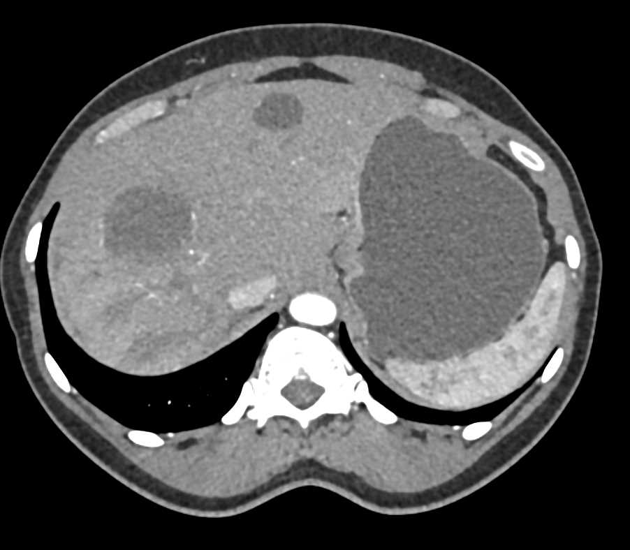 Carcinoma Tail of Pancreas with Liver Metastases - CTisus CT Scan