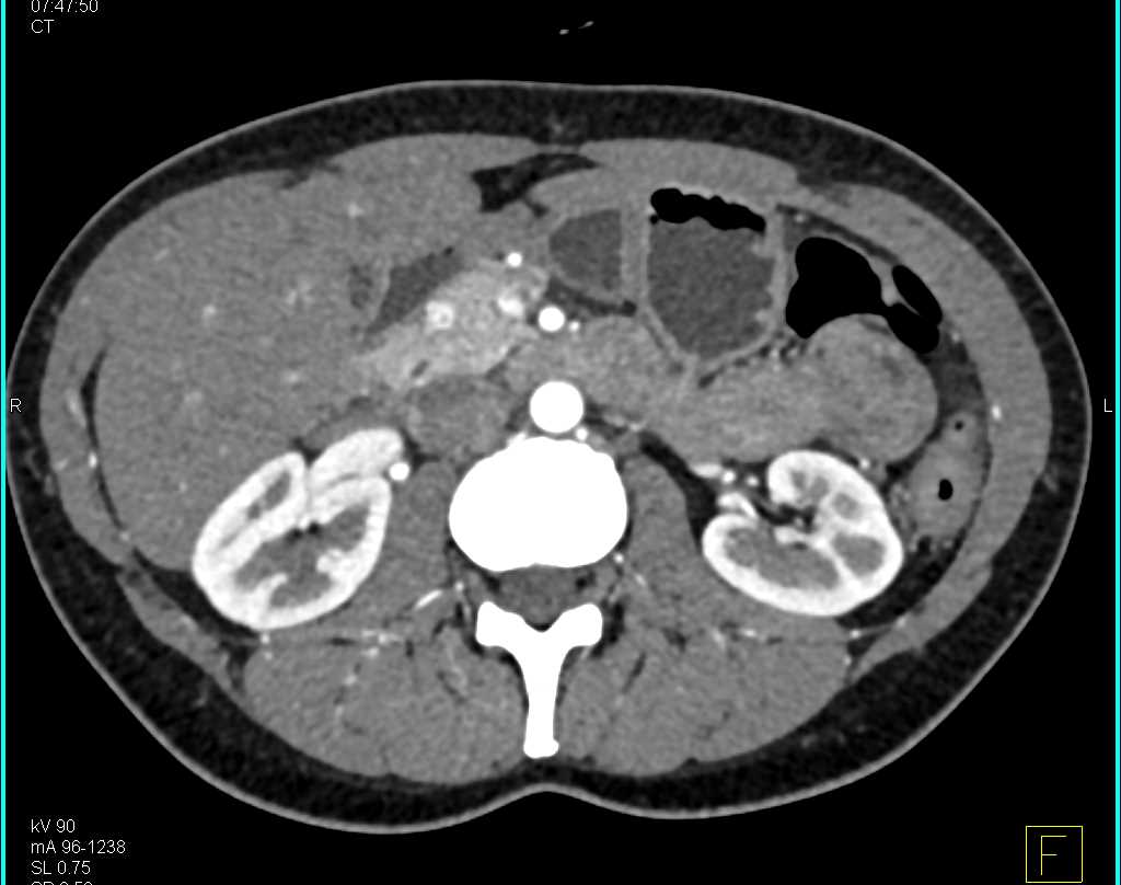 1 cm Neuroendocrine Tumor in the Head of the Pancreas - CTisus CT Scan