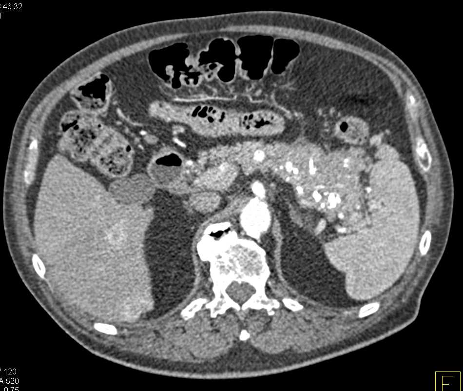 Neuroendocrine Tumor in the Tail of the Pancreas - CTisus CT Scan