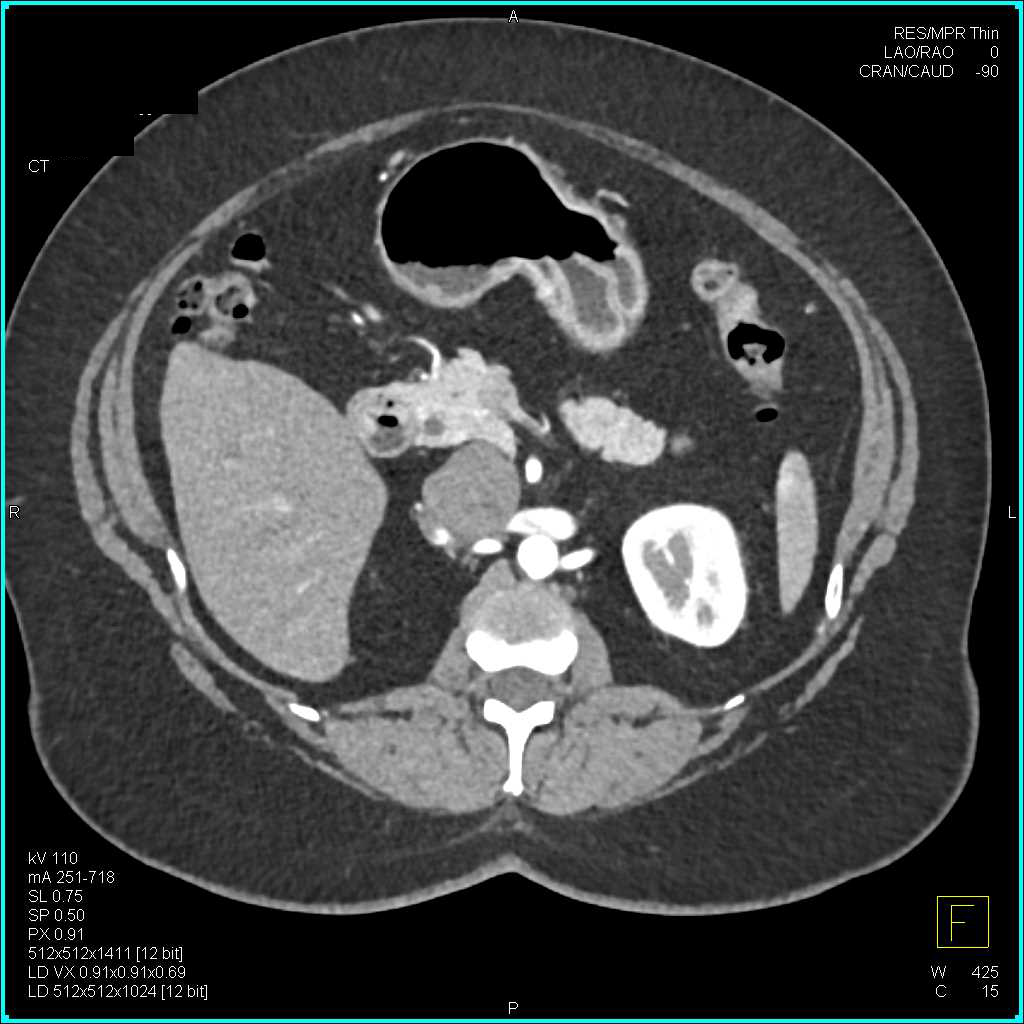 Paraganglioma Near the Head of the Pancreas - CTisus CT Scan