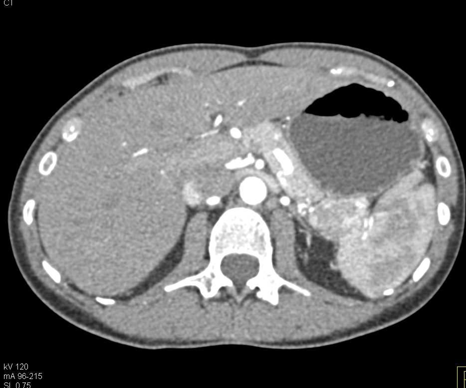 Carcinoma Tail of Pancreas and Incidental Pulmonary Embolism (PE) - CTisus CT Scan