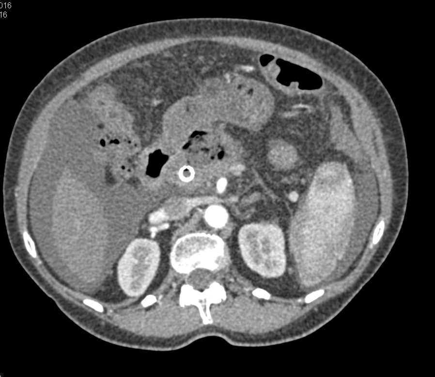 Invasive Pancreatic Cancer with Liver Metastases - CTisus CT Scan