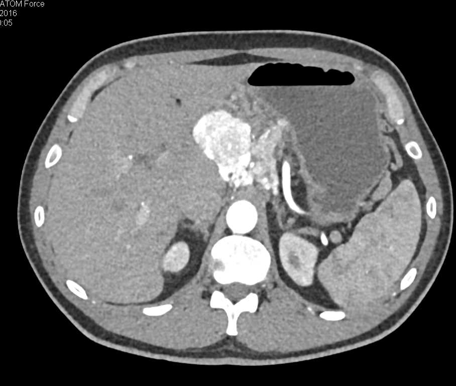 Neuroendocrine Tumor of the Pancreas - CTisus CT Scan