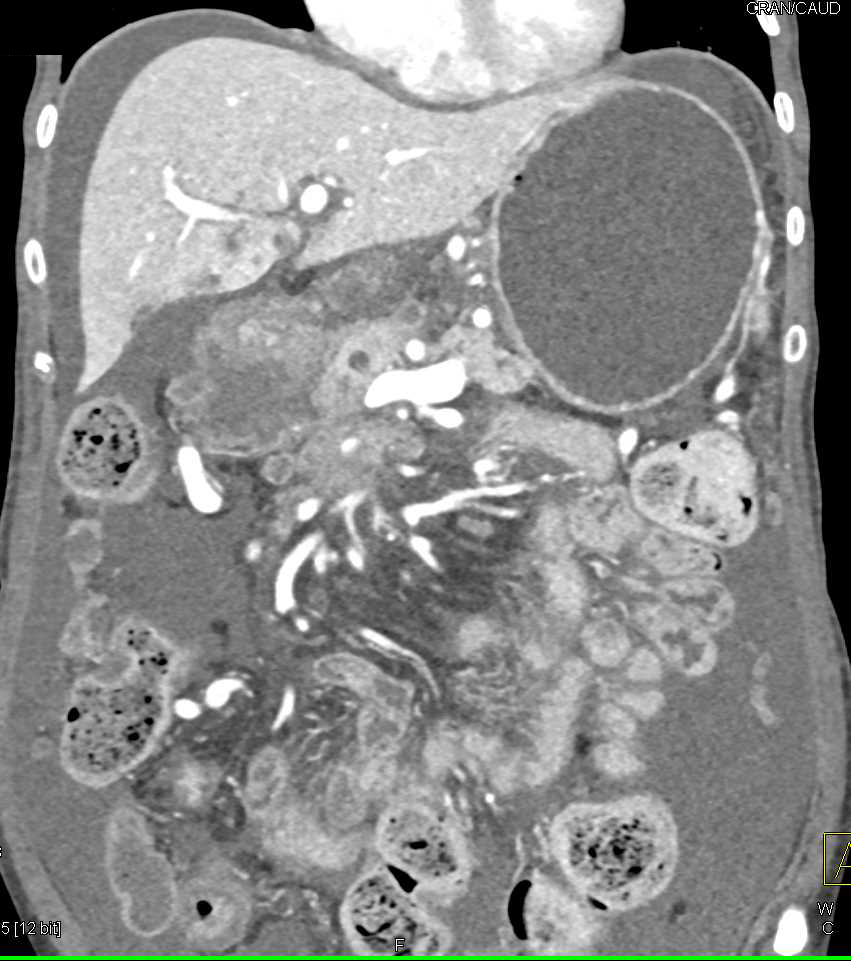 Pancreatic Adenocarcinoma with Vessel Encasement and Collaterals - CTisus CT Scan